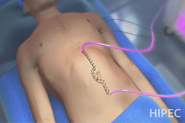 Risks of HIPEC Surgery